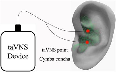 Early Fractional Amplitude of Low Frequency Fluctuation Can Predict the Efficacy of Transcutaneous Auricular Vagus Nerve Stimulation Treatment for Migraine Without Aura